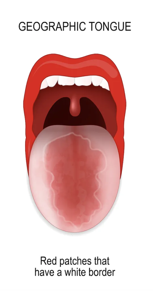Geographic Tongue