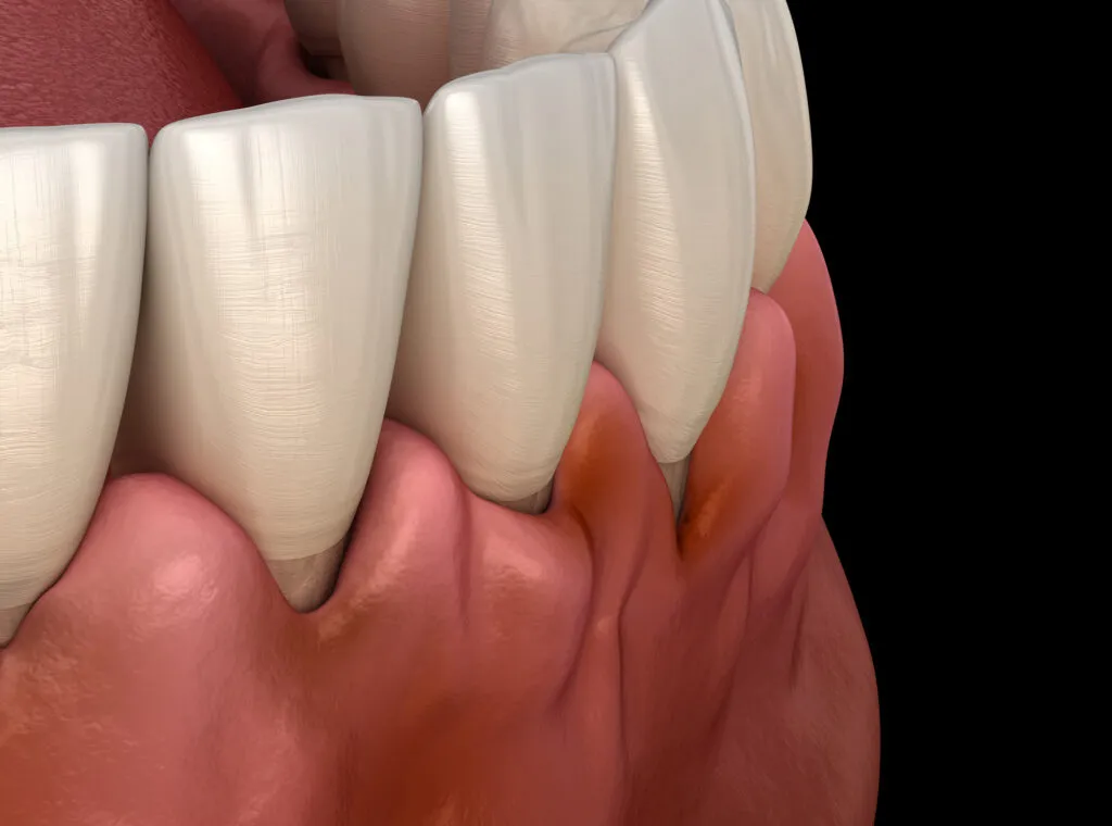 Gingivitis inflammation of the gums causing loose teeth medically accurate 3D render