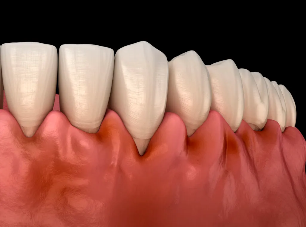 Gingivitis inflammation of the gums dental 3D illustration