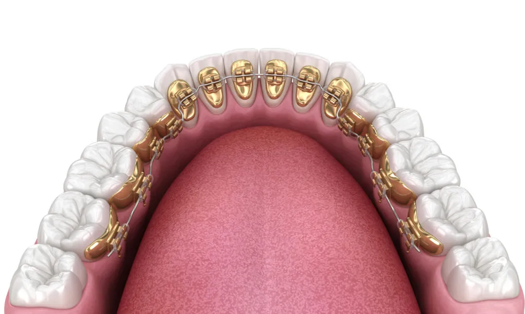 Gold braces back render