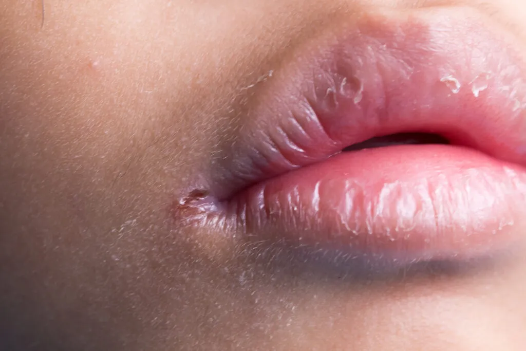 Close-up image of chapped lips with visible dryness and a small crack at the corner of the mouth.