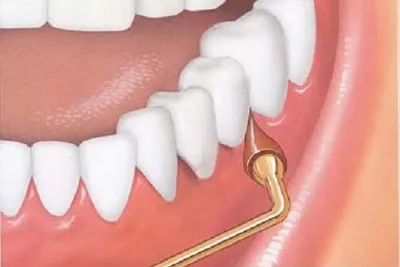 What is a Gum Stimulator?