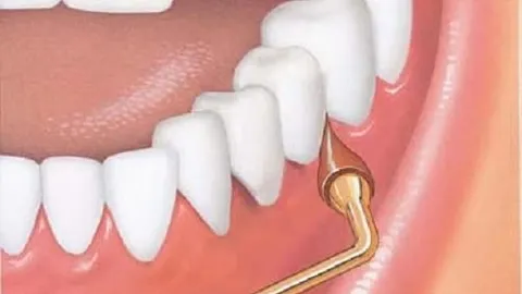 What is a Gum Stimulator?