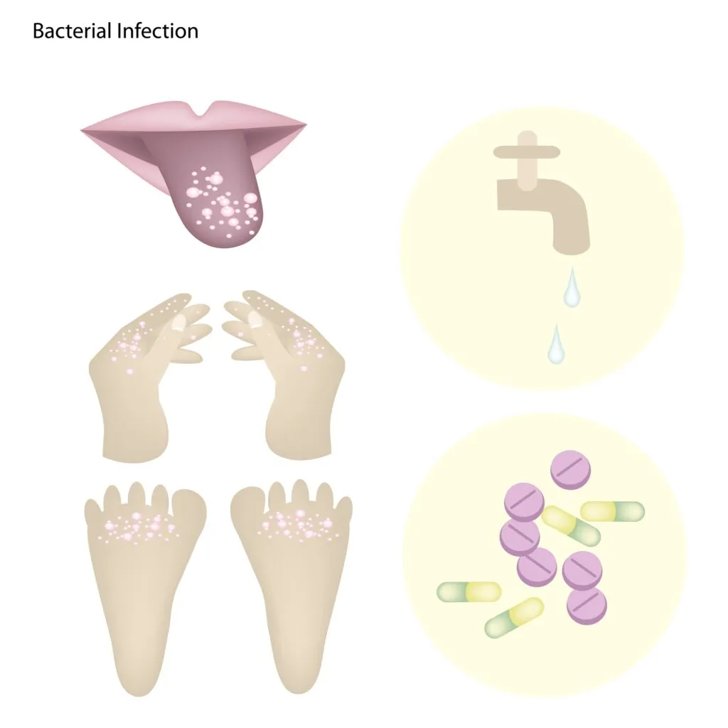 Hand Foot and Mouth disease symptoms medical illustrations