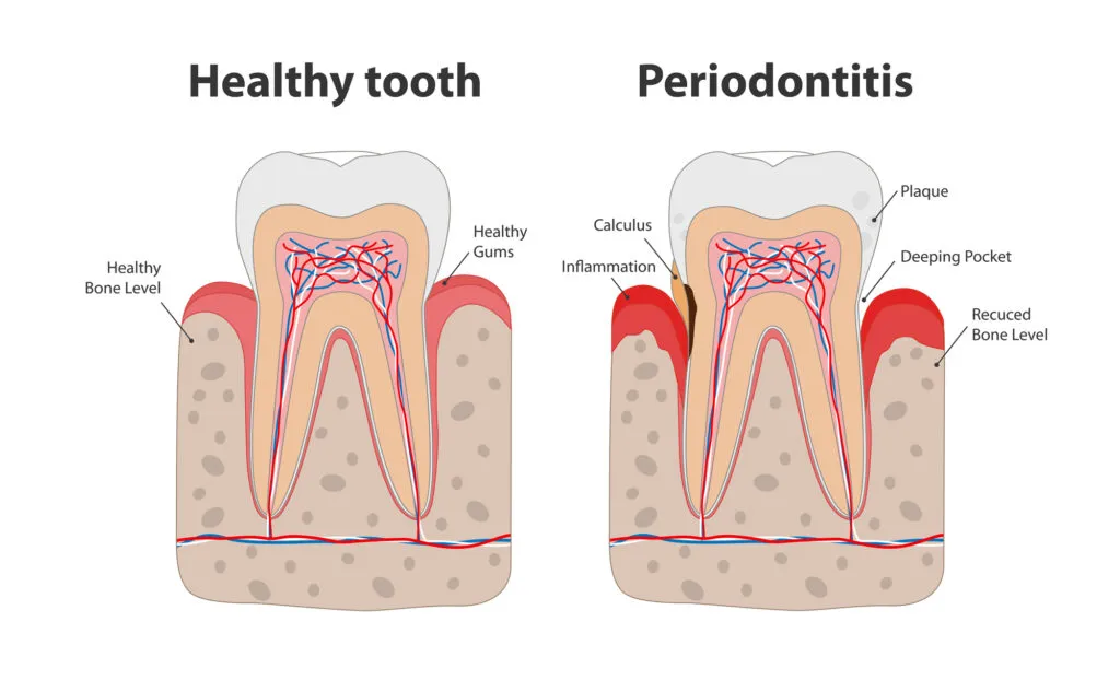 Healthy tooth and unhealthy tooth with periodontitis comparison illustration