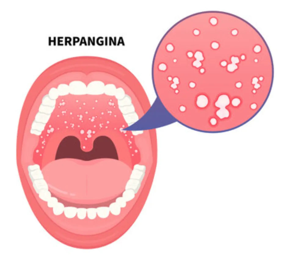 Herpangina screenshot