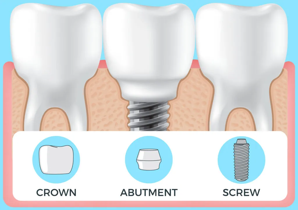 Human jaw with normal teeth and prosthesis above dental implant structure
