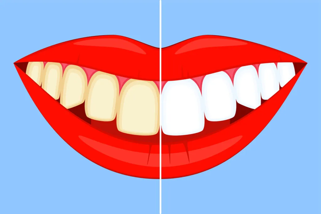 Illustrated comparison of a divided smile with healthy white teeth on the right side and yellowish coffee stained teeth on the left side