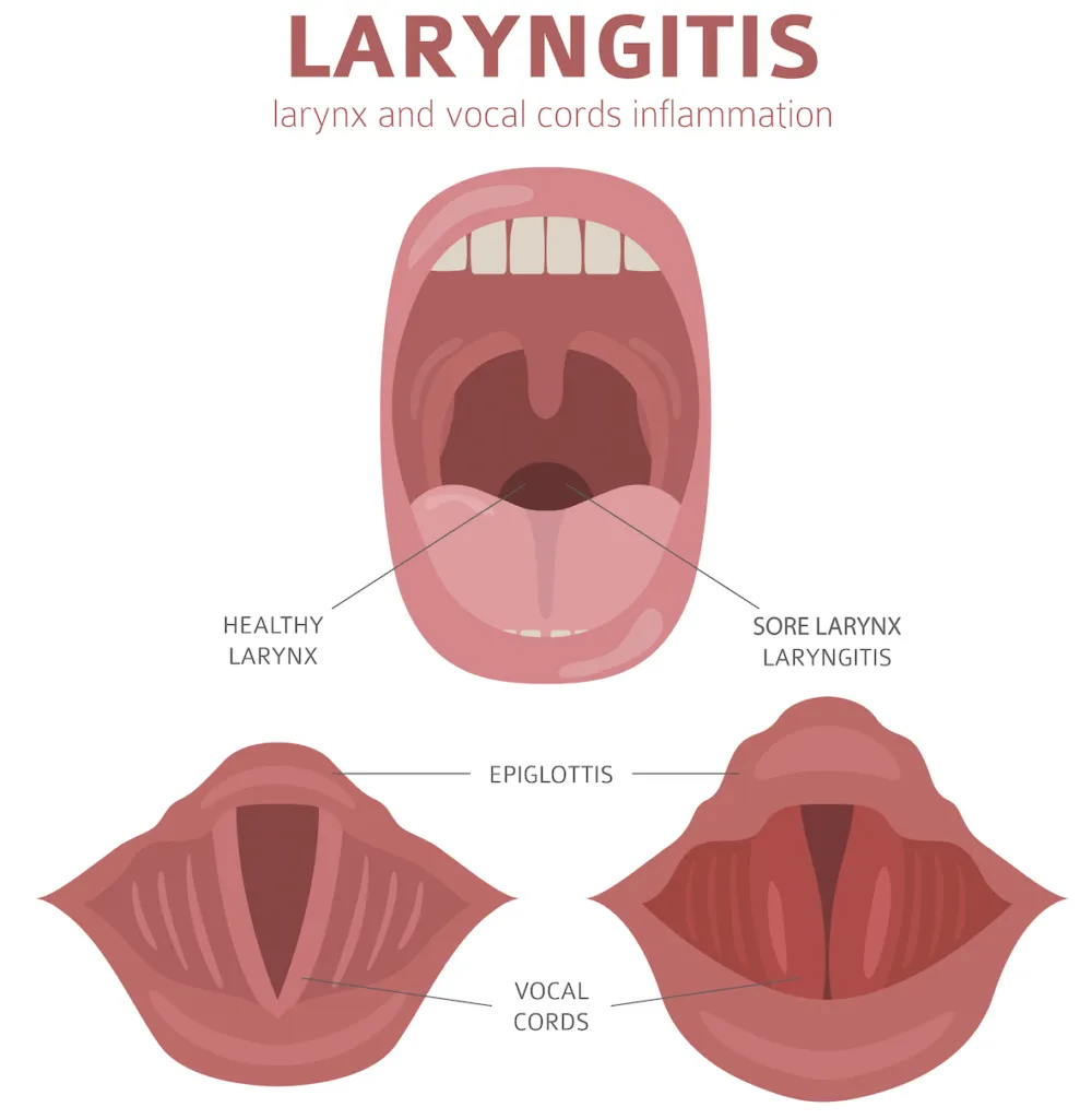 Illustration and chart of Laryngitis