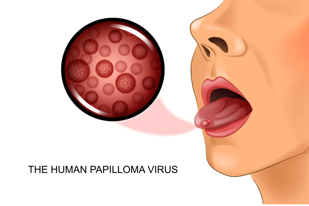 Illustration of The human papilloma virus or warts on tongue