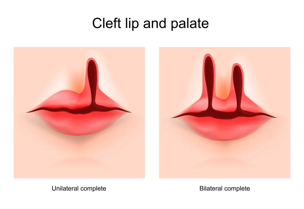 Illustration of a face of a child with a defect cleft