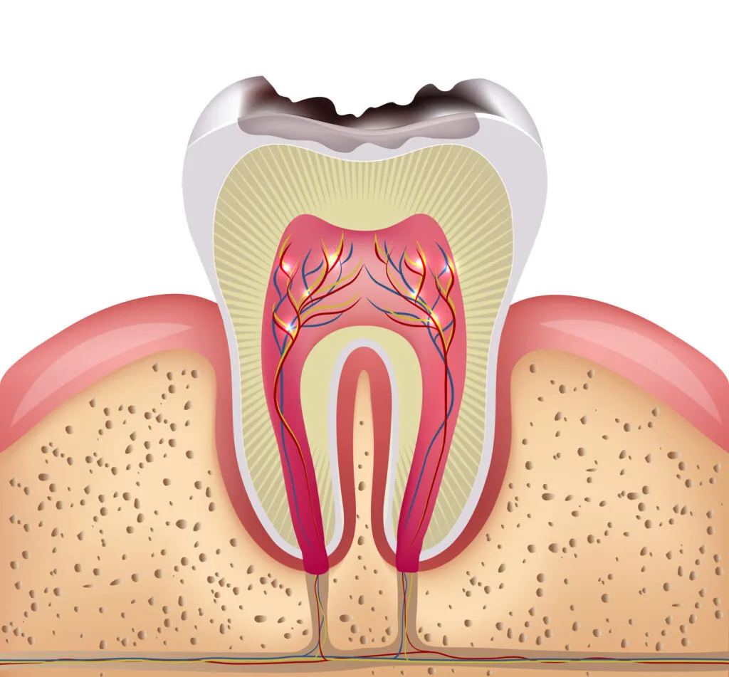 Illustration of example of rotting teeth due to having meth mouth