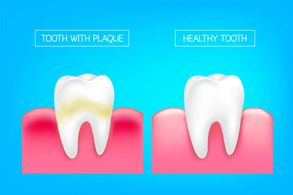 Illustration showing tooth with plaque and healthy tooth comparision