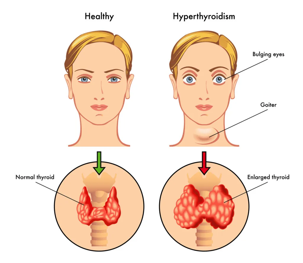 Illustrations comparing a healthy human throat to a throat with hyperthyroidism