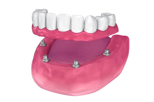 Implant Retained Dentures Newmouth