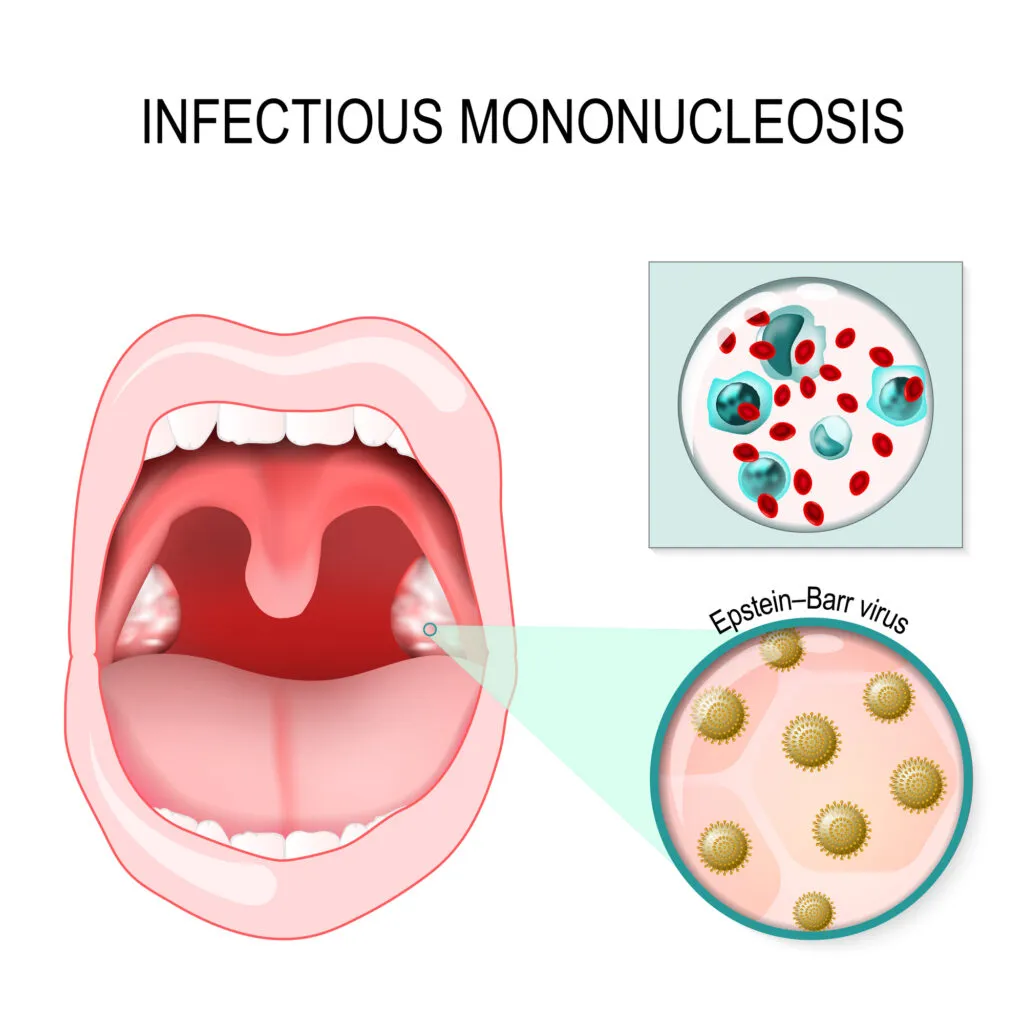 Infectious mononucleosis medical illustration