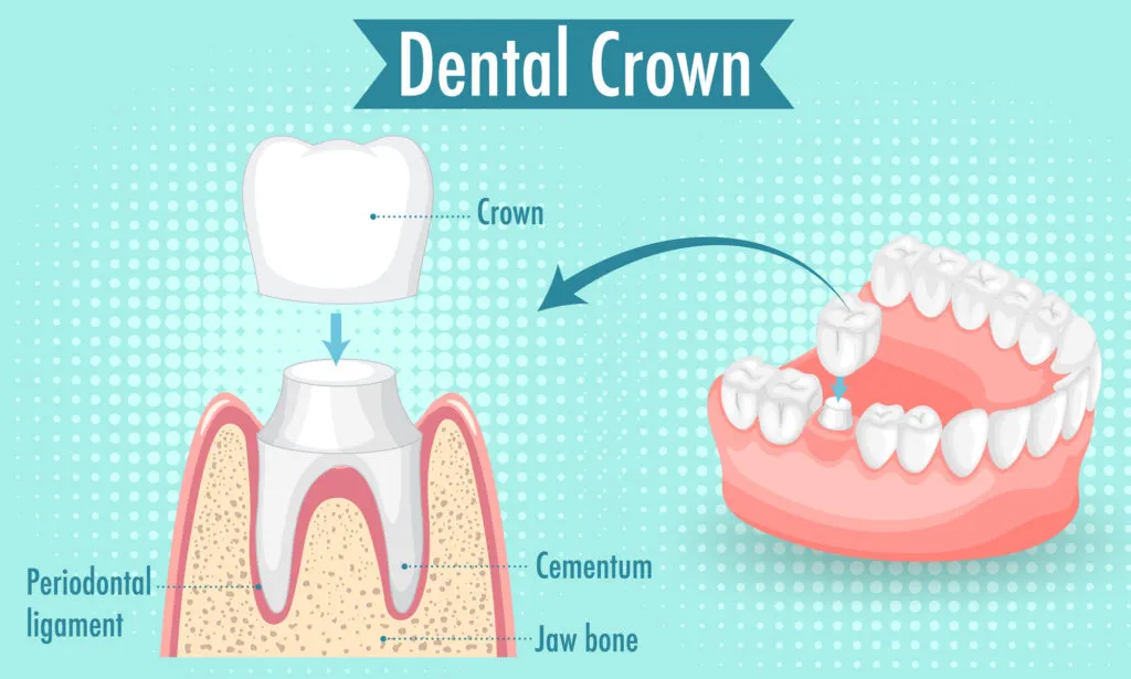 Infographic of human in dental crown illustration