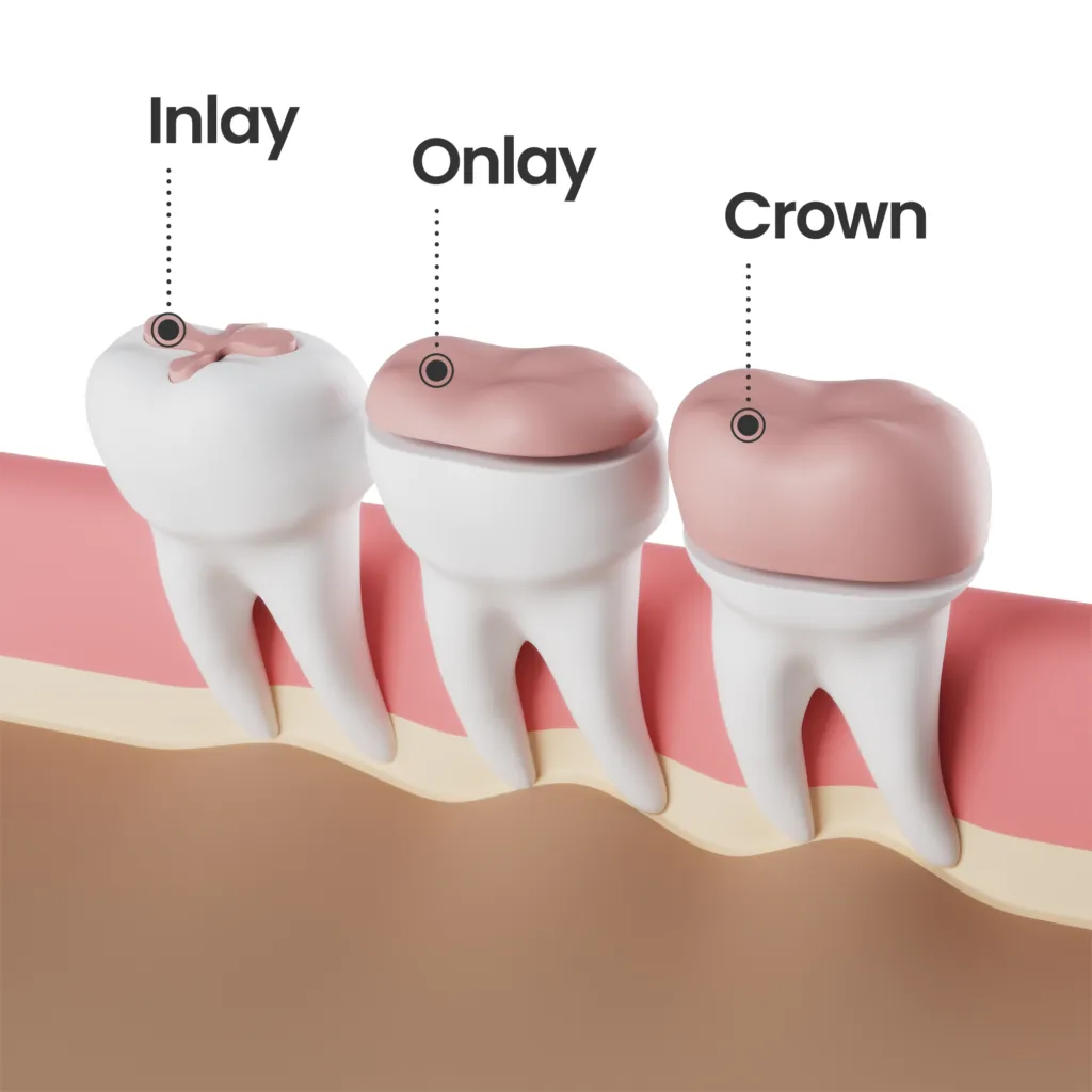 Inlay, Onlay & Dental Crown