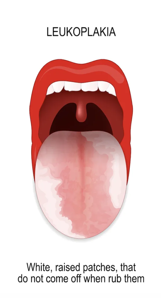 Leukoplakia