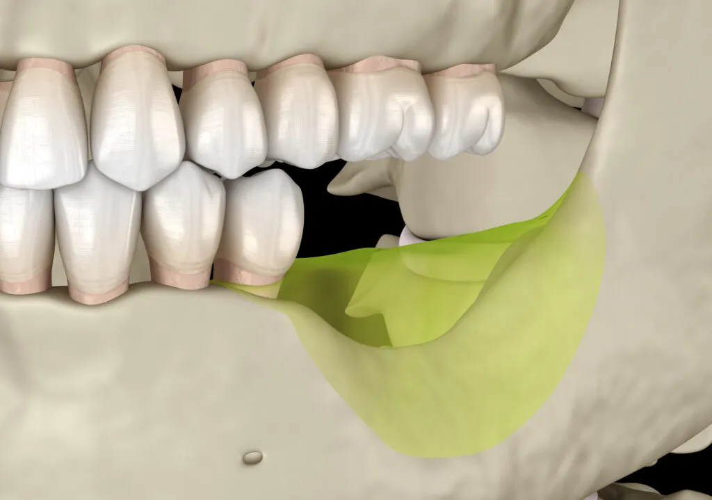Mandibular Jaw bone recession after losing molars teeth