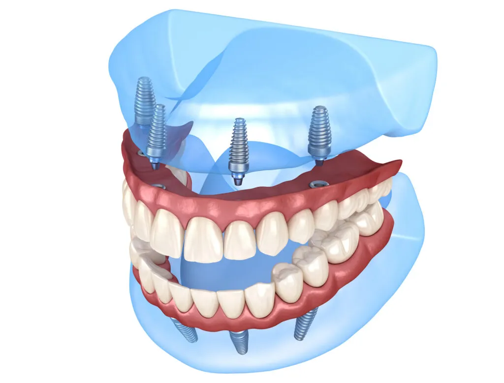 Maxillary and Mandibular prosthesis with gum All on 4 system supported