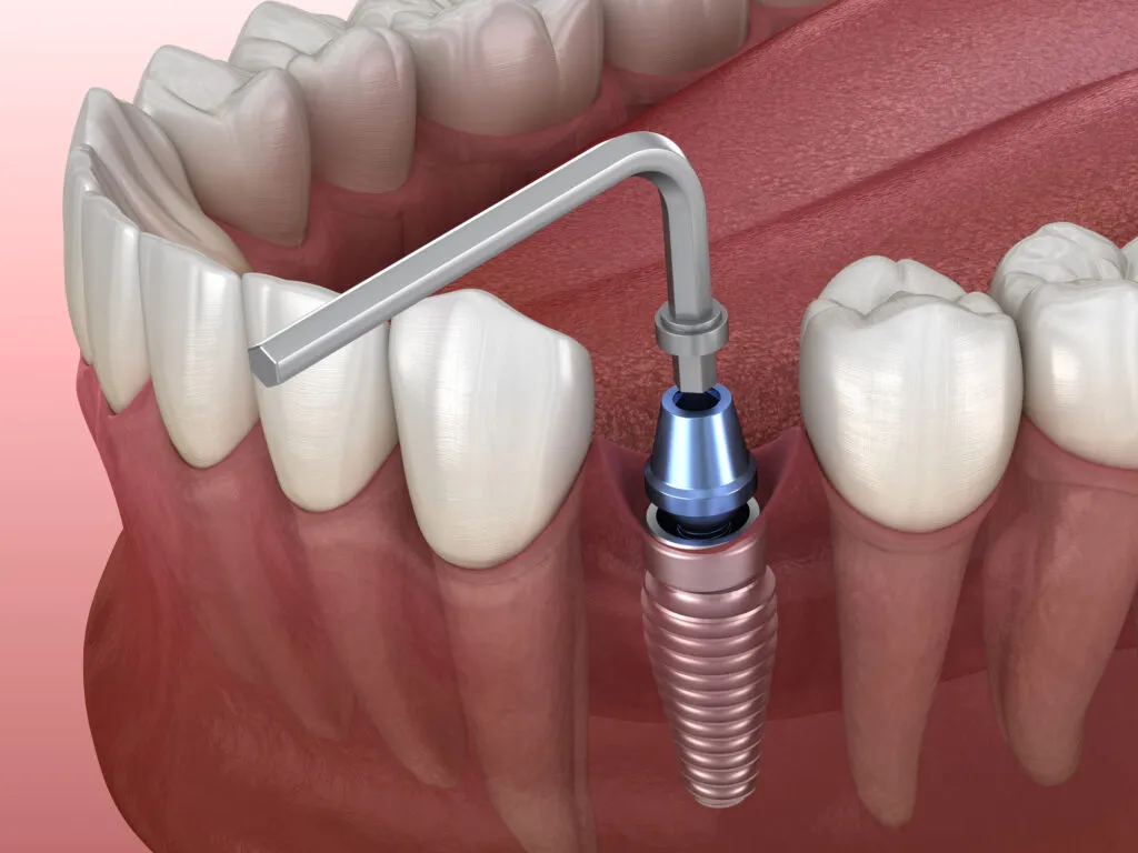 Medically accurate 3D render of an Implant abutment fixation procedure