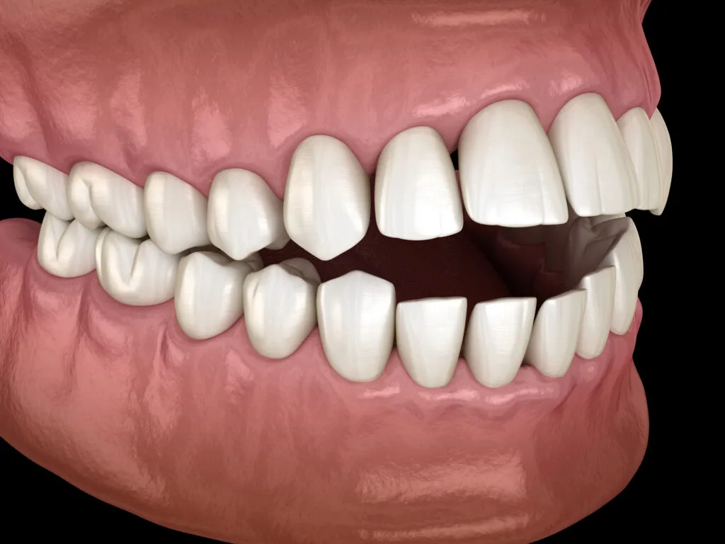 Medically accurate 3d render of an Open bite dental occlusion due to Malocclusion of teeth
