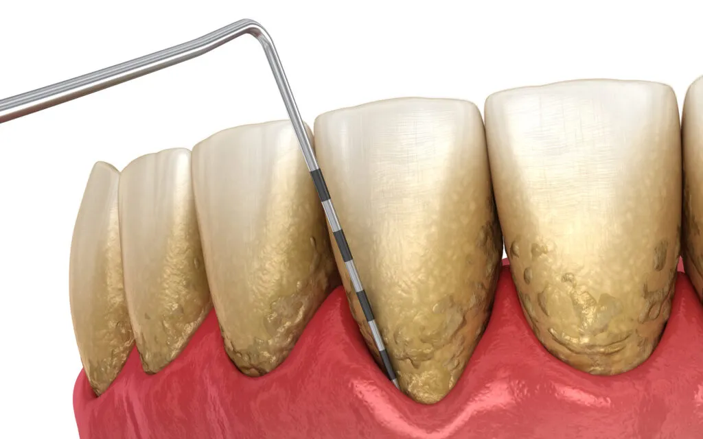 Dental probe measuring periodontal pocket depth on teeth with visible plaque and gum inflammation.