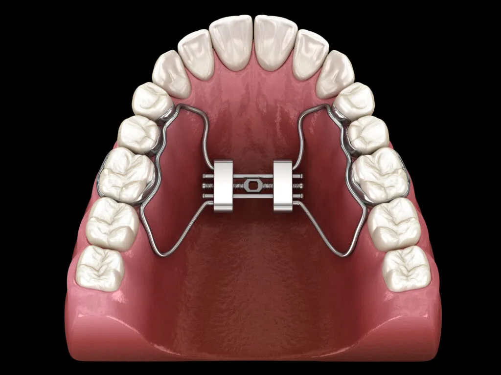 Medically accurate tooth 3D illustration of Rapid Palatal Expansion.