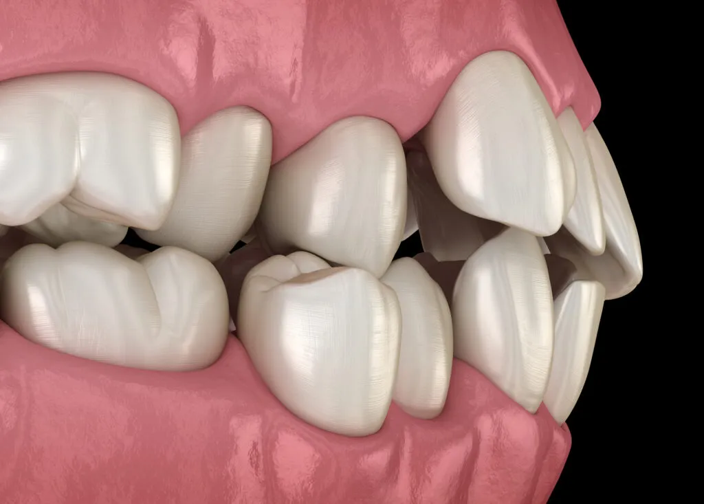 Misaligned teeth or malocclusion 3d render