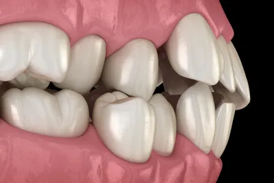 Crowded Teeth: Causes, Treatment & Risks