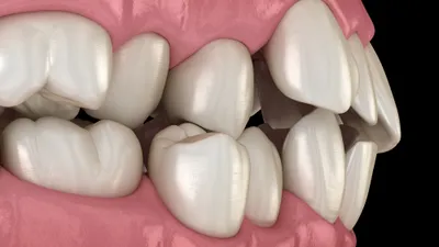 Crowded Teeth: Causes, Treatment &amp; Risks