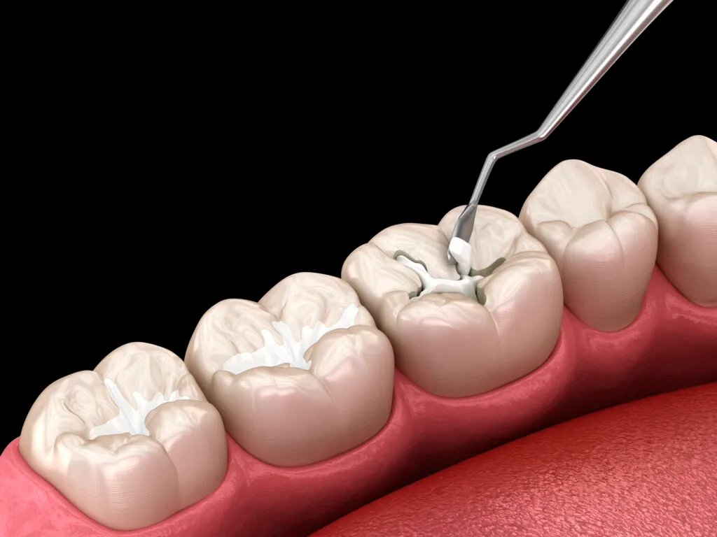 Molar tooth fissure restoration with filling
