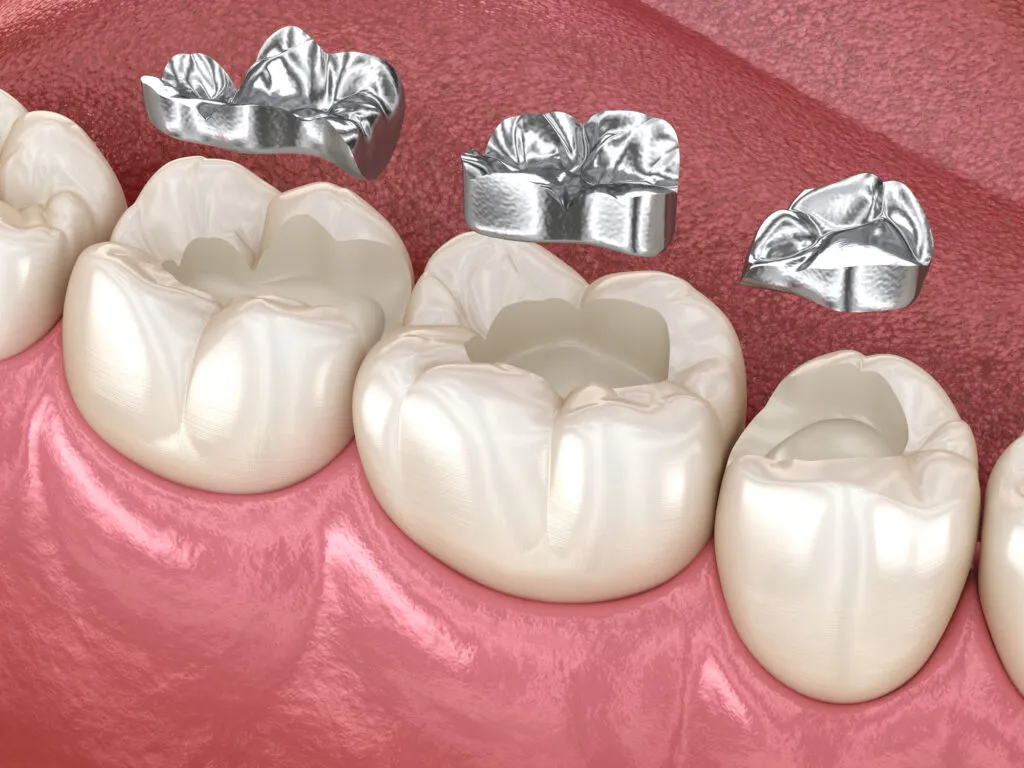 Molar tooth fissure restoration with filling fell out