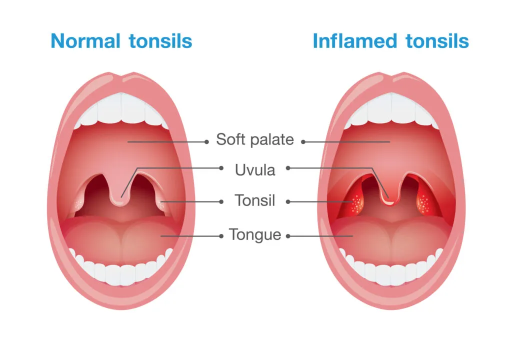 Normal tonsils and inflamed tonsils comaprison illustration