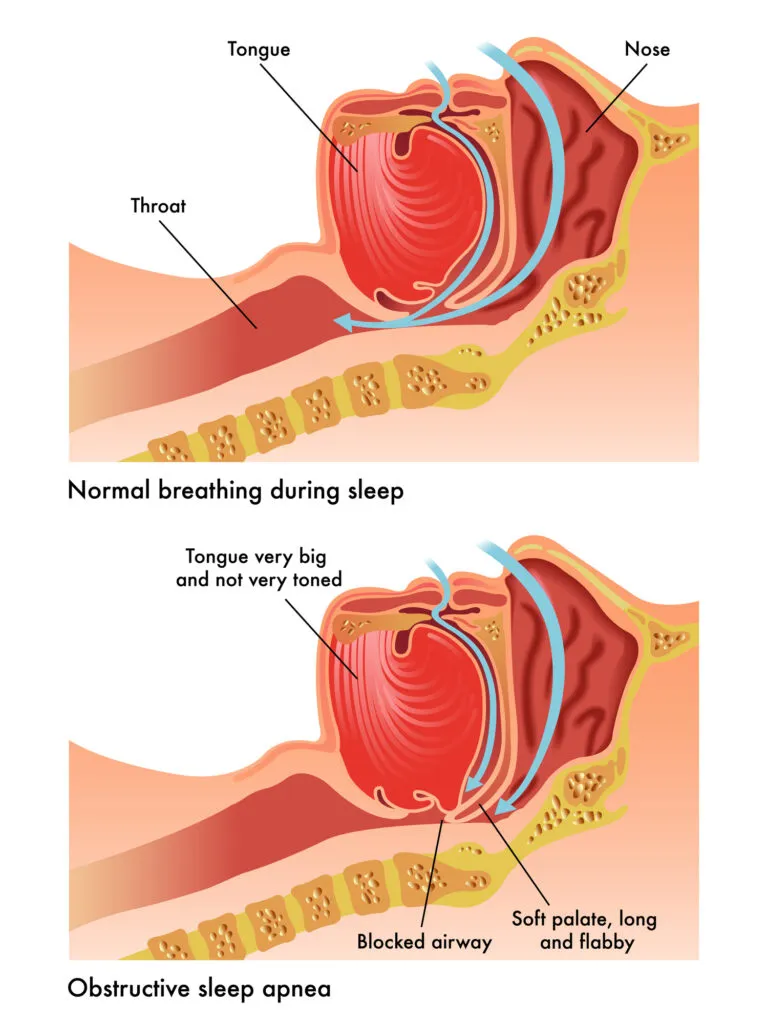 Obstructive sleep apnea