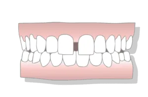 Open Bite Treatment Options