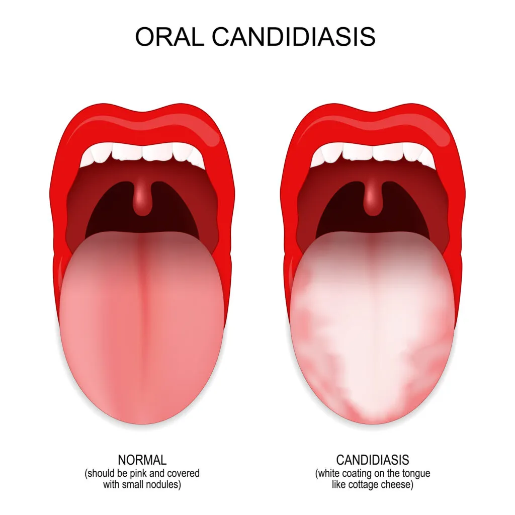 Oral Candidiasis medical illustration