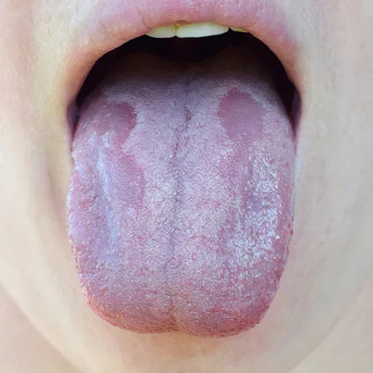 Oral Thrush