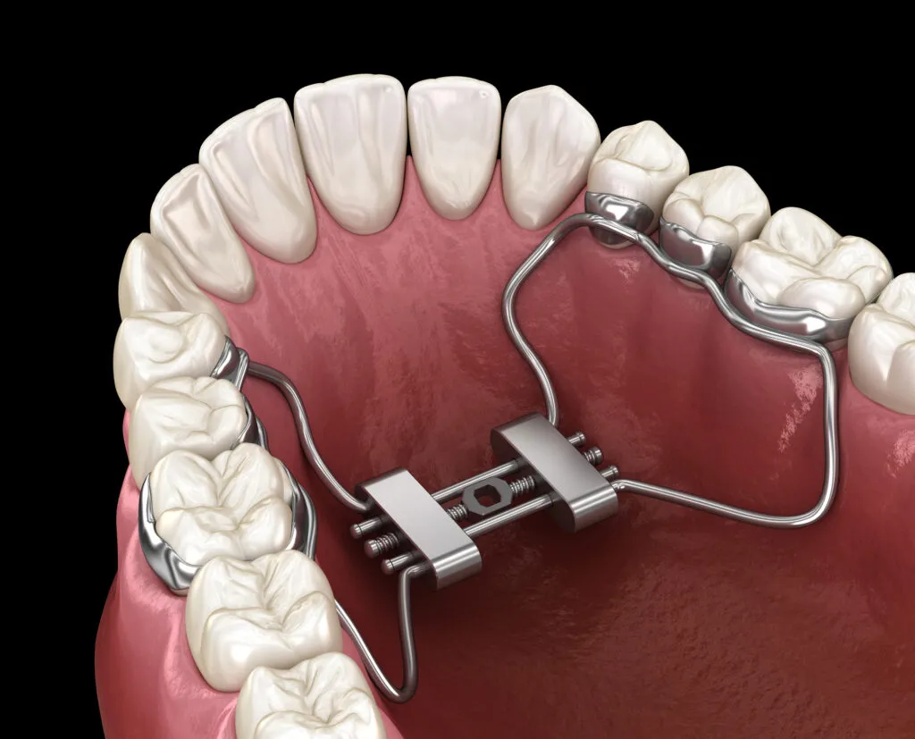 Palate or Palatal Expander on Medically accurate tooth 3D illustration