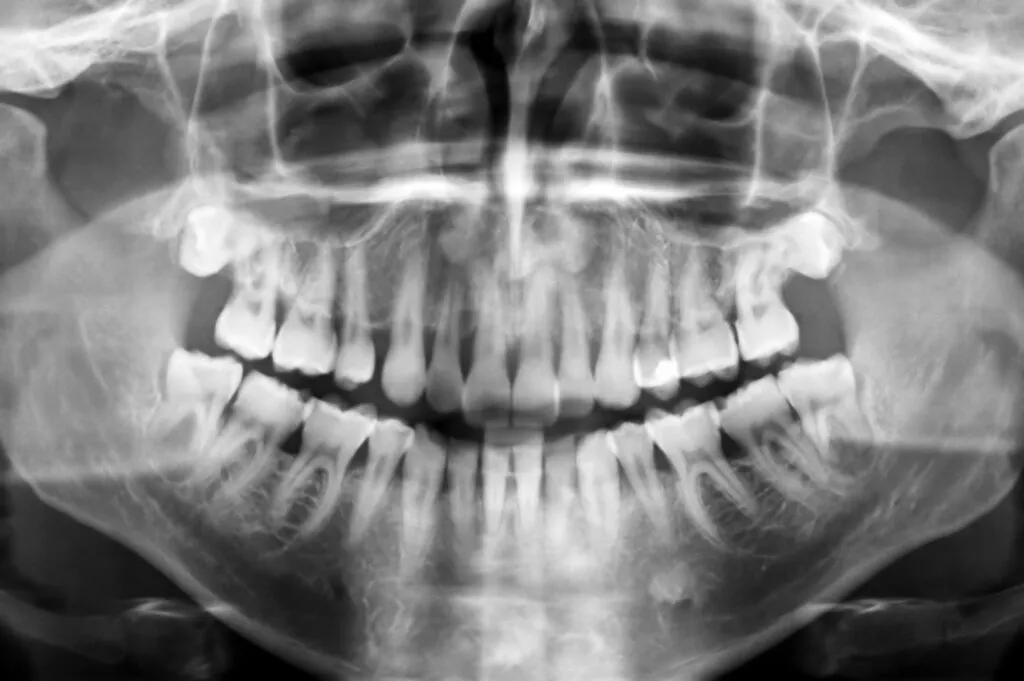 Panoramic Dental X Ray Of Human Teeth