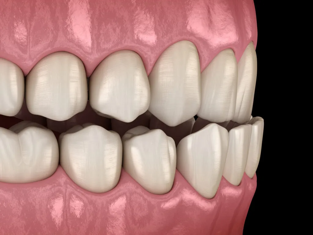 Posterior Open Bite with upper and lower jaw teeth not overlapping