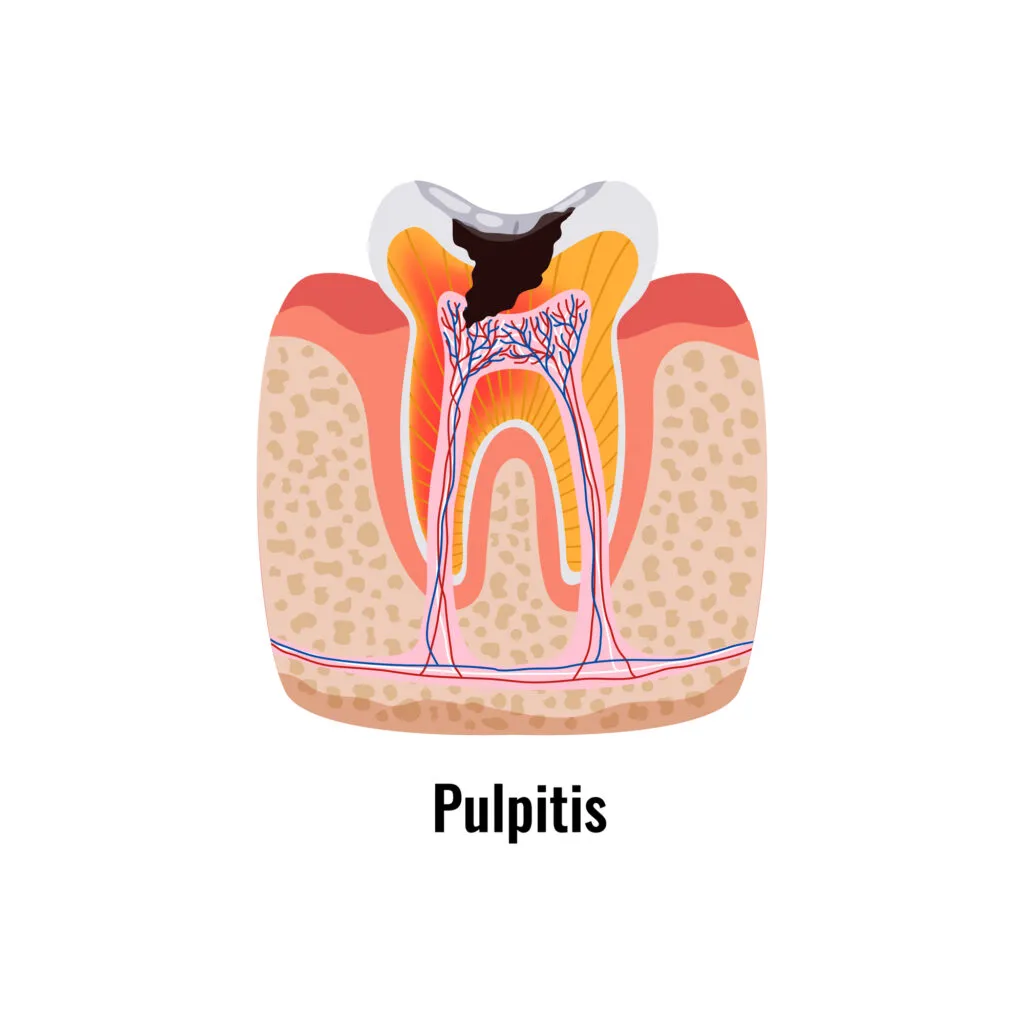 Pulpitis illustration
