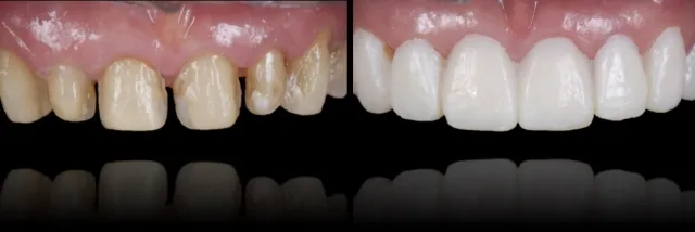 Removable Veneers 4