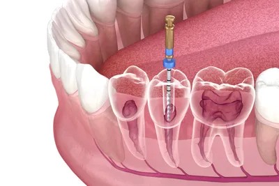 Root Canal Cost (With and Without Insurance)