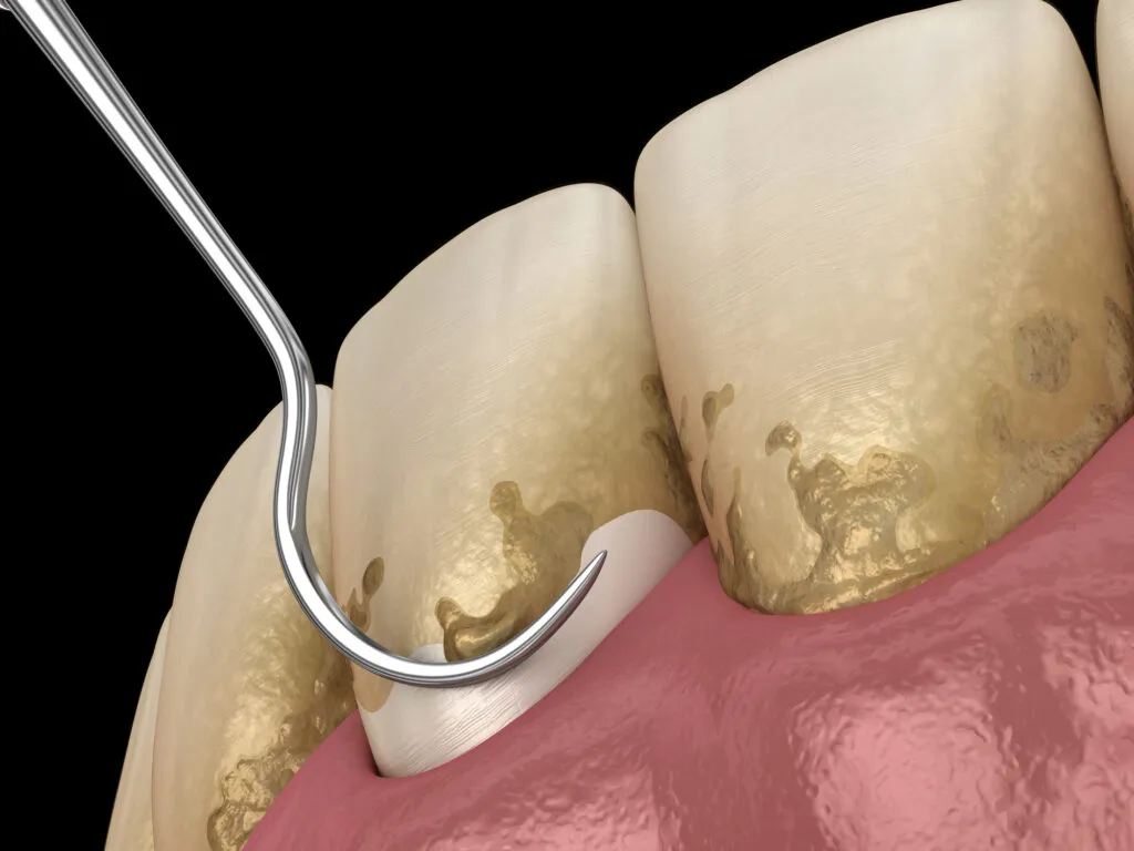 Scaling and root planing conventional periodontal