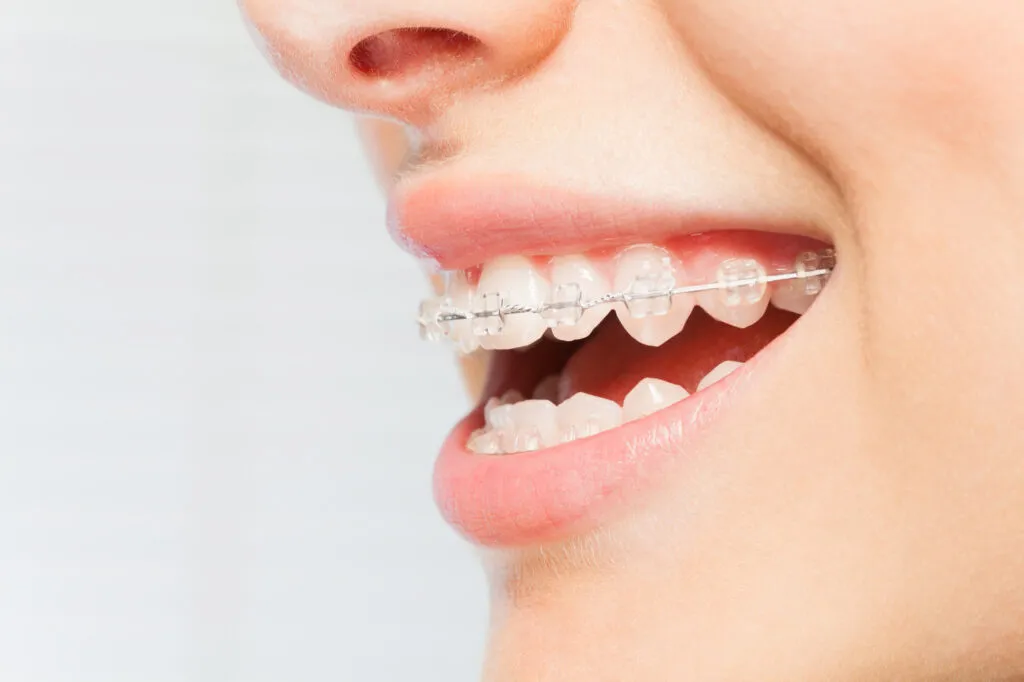 Side view picture of womans smile with clear dental braces on