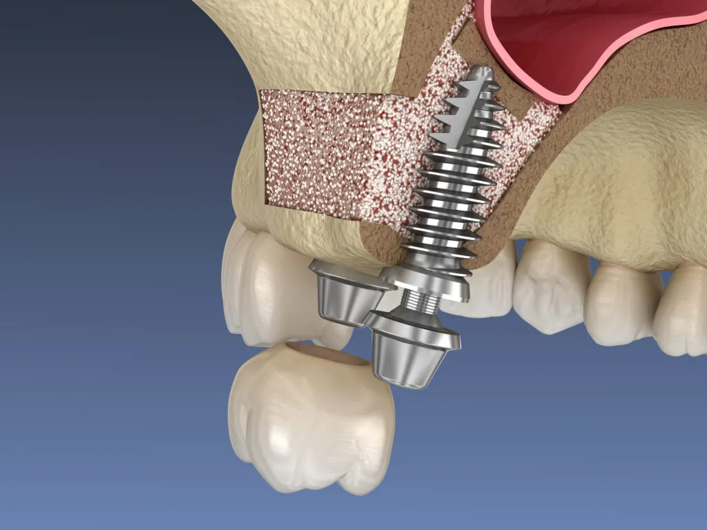 Sinus Lift Surgery implant installation