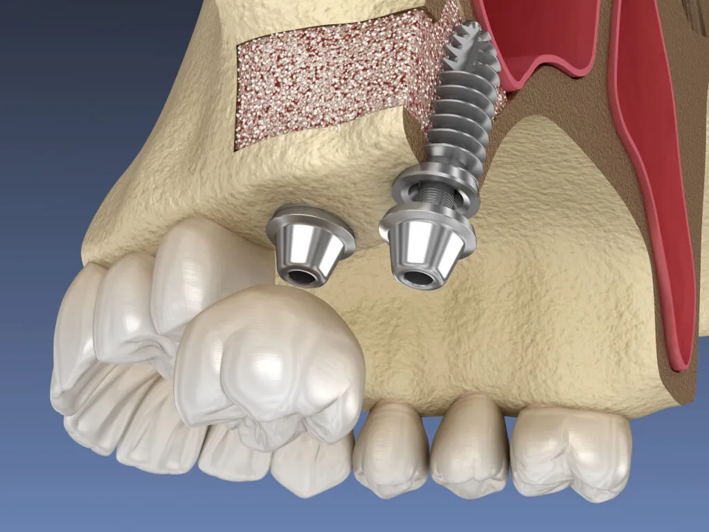 Sinus Lift Surgery implant installation 3d illustration