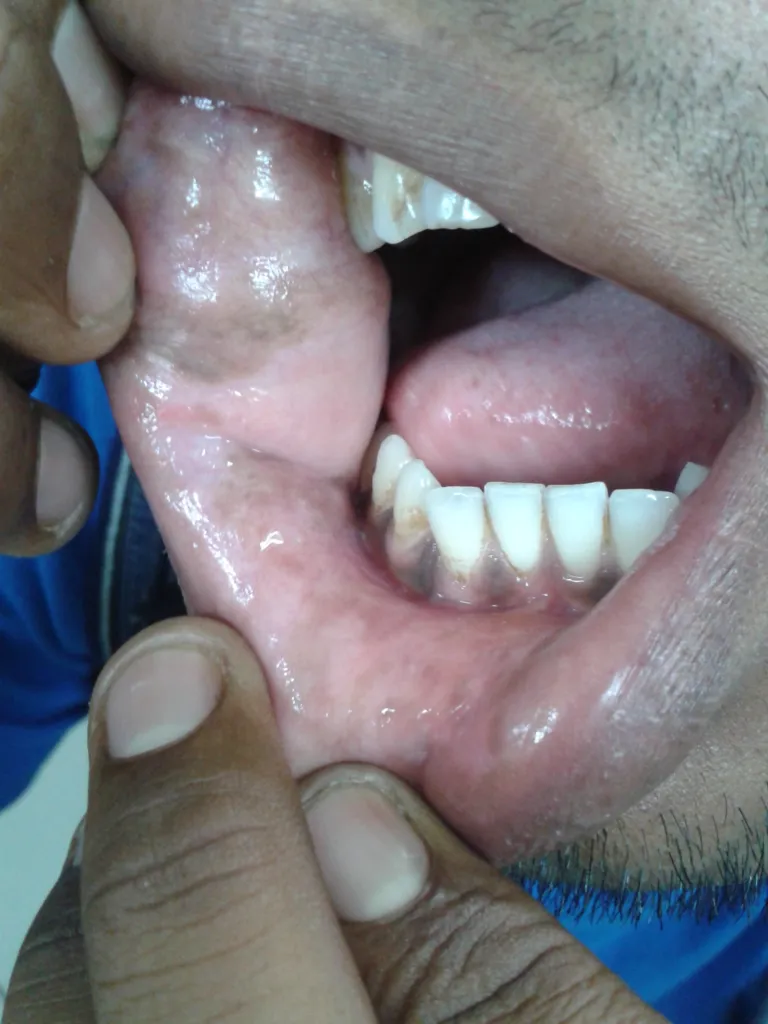 Close-up of a person pulling down their lower lip to show teeth and gums.